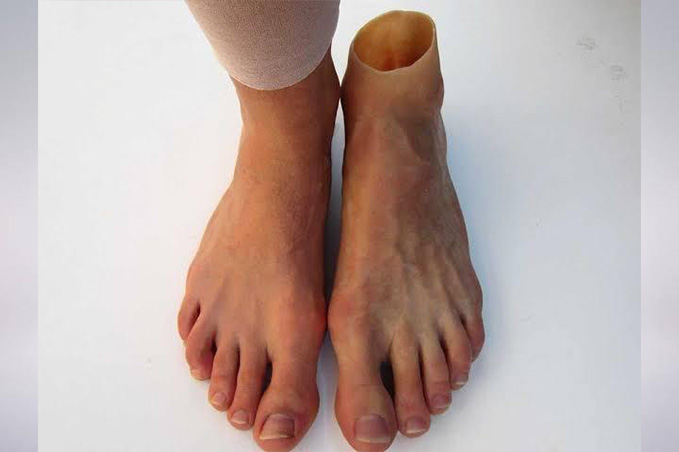 Prosthetics and Orthotics